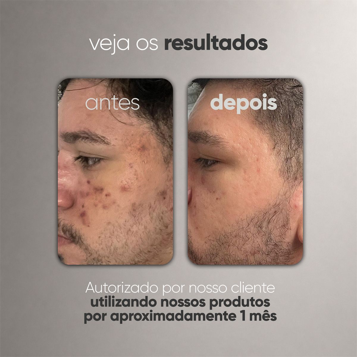 ANTIACNE - Gel Creme Antiacne - 30g , foto 6