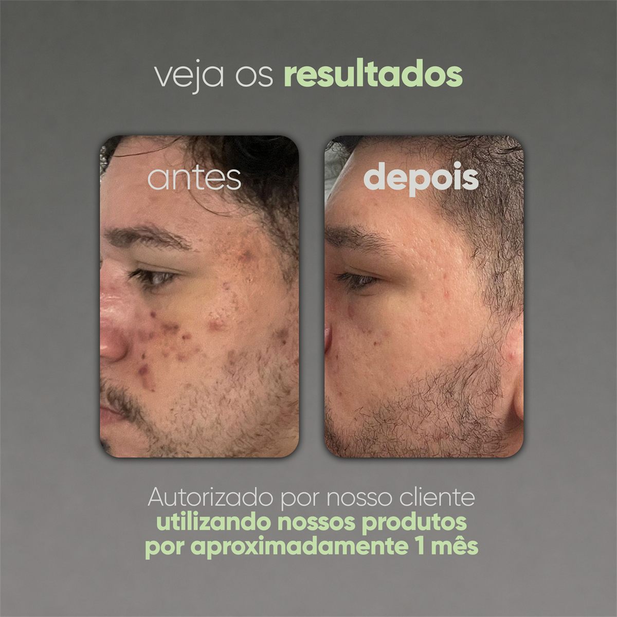 LIMPA ANTIACNE - Gel de Limpeza Antiacne Facial - 65g, foto 6